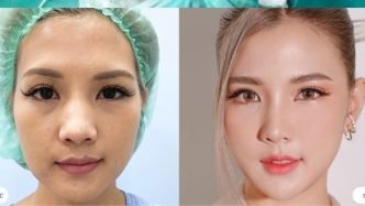 Review Dịch Vụ Cắt Mí Tại Bệnh Viện Thẩm Mỹ Sao Hàn