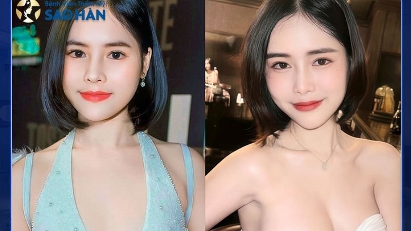 Trước và sau khi nâng ngực – Hình ảnh thực tế