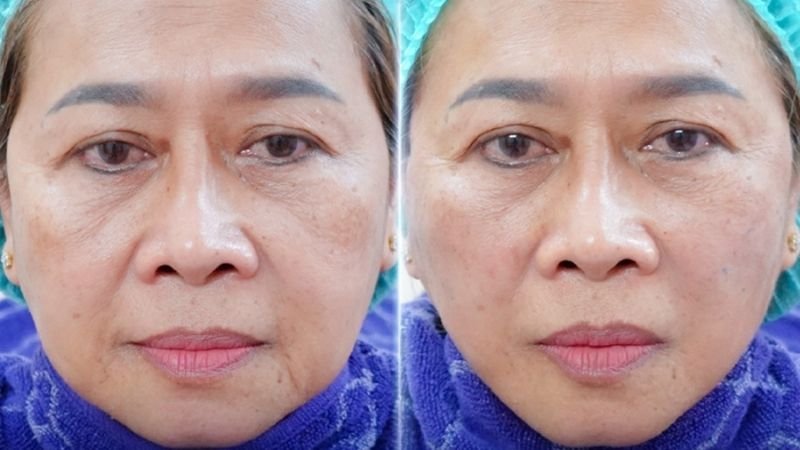 Review Dịch Vụ Căng Da Mặt Tại Bệnh Viện Sao Hàn