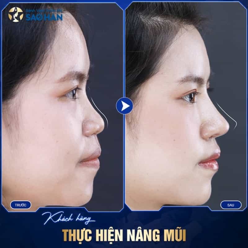 dịch vụ nâng mũi bệnh viện sao hàn