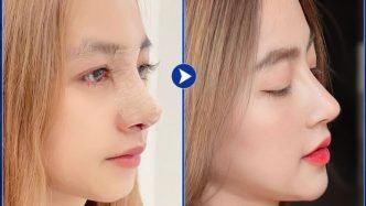 nâng mũi tại bệnh viện sao hàn có tốt không
