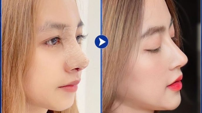nâng mũi tại bệnh viện sao hàn có tốt không