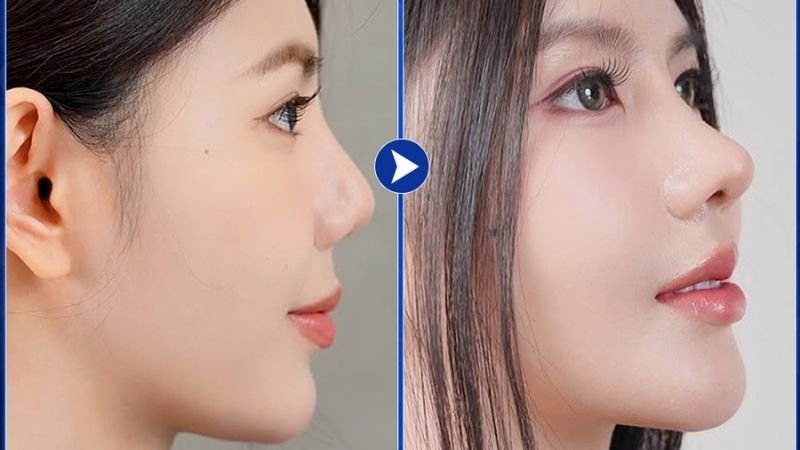 Review Dịch Vụ Nâng Mũi Tại Bệnh Viện Sao Hàn