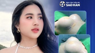 Review Dịch Vụ Nâng Ngực Tại Bệnh Viện Sao Hàn