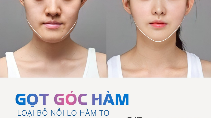 Dịch vụ chỉnh hàm lệch tại Bệnh viện Thẩm mỹ Sao Hàn – An toàn và hiệu quả