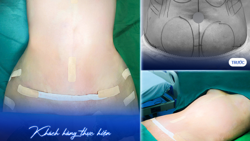 Khách hàng tự tin với vóc dáng sau khi hút mỡ toàn thân