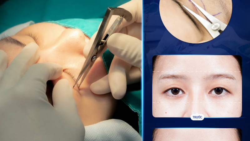 Dịch vụ mí đôi tự nhiên tại bệnh viện Sao Hàn - Phương Pháp Cắt Mắt To Tròn năm 2025