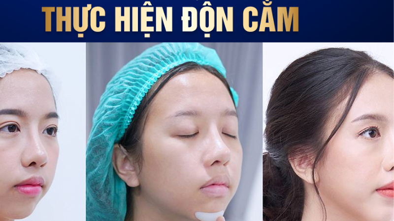 Dịch vụ tạo hình gương mặt V-line - Giải pháp làm đẹp không thể bỏ lỡ