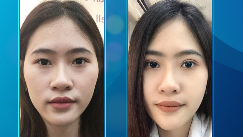 Lấy mỡ mí mắt trên – Làm ở đâu uy tín tại TP.HCM