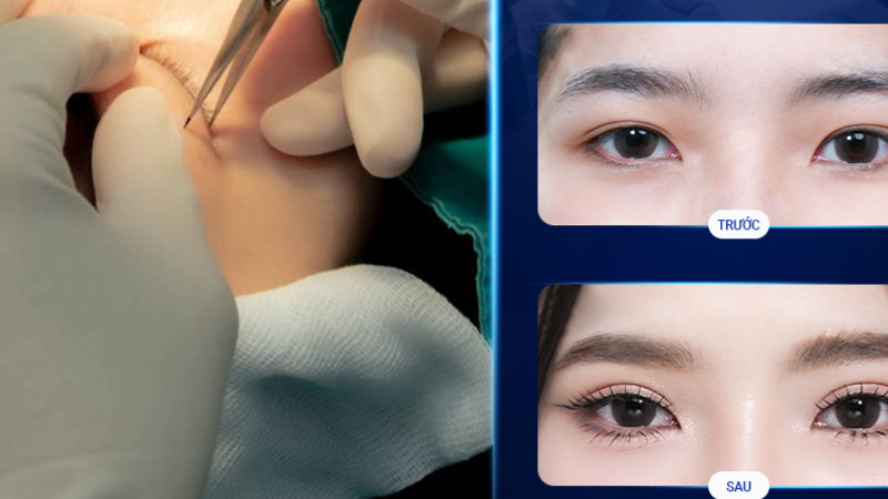 Quy Trình Tạo Mí Đôi Tự Nhiên Tại Bệnh viện Sao Hàn