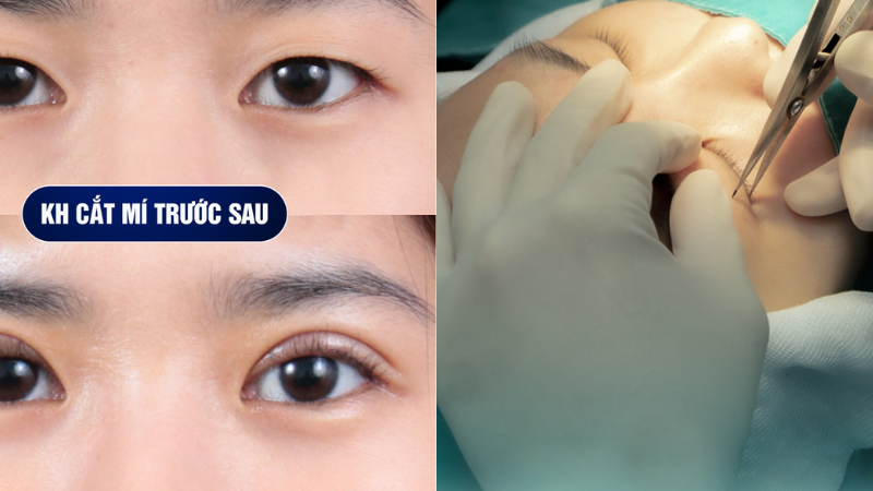 Lấy mỡ mí mắt trên – Làm ở đâu uy tín tại TP.HCM