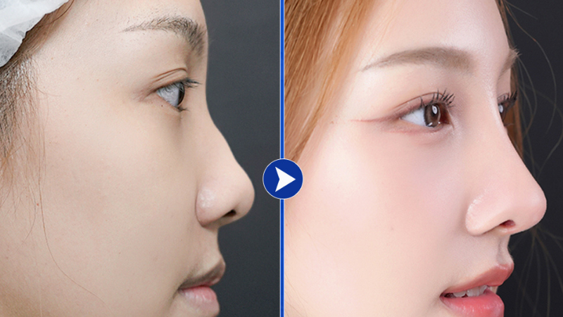 Nâng mũi bằng sụn tự thân tại Bệnh viện Sao Hàn mang lại dáng mũi đẹp tự nhiên