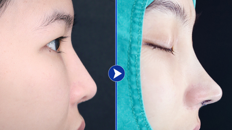 Nâng mũi bằng sụn tự thân tại Bệnh viện Sao Hàn mang lại dáng mũi đẹp tự nhiên