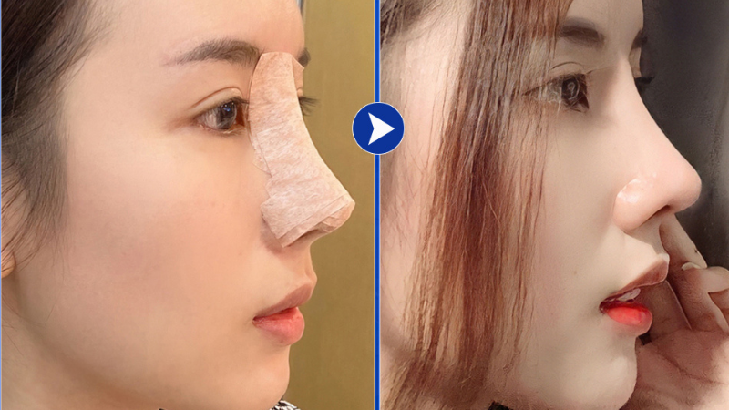 Hình ảnh khách hàng sau 6 tháng nâng mũi sụn tự thân tại Sao Hàn