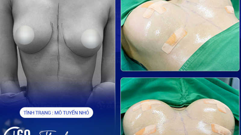 Ca tái phẫu ngực chảy xệ sau sinh tại Bệnh viện Sao Hàn