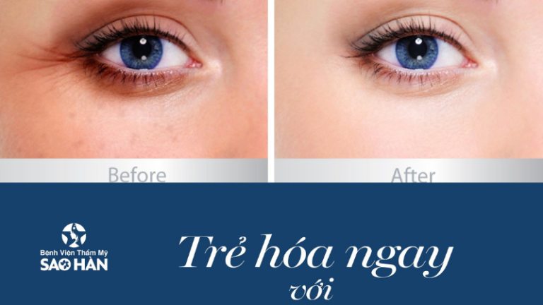 Điều trị nếp nhăn vùng mắt