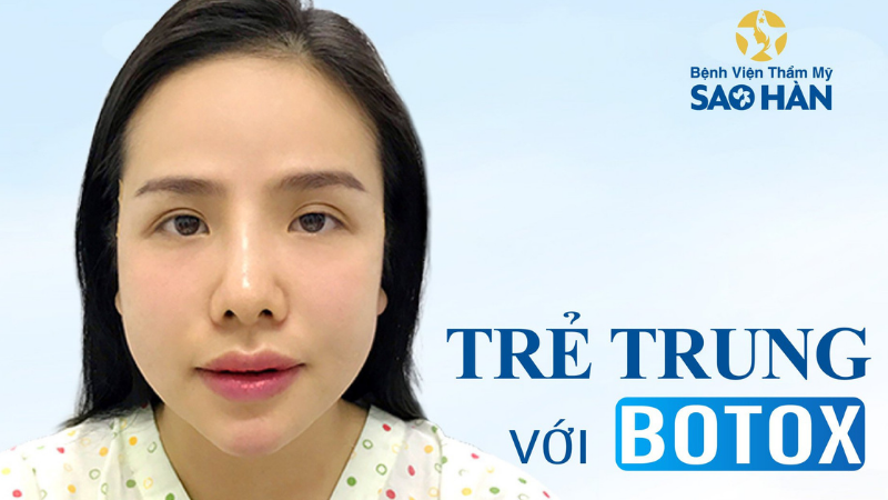 Gương mặt V-line nhờ tiêm botox