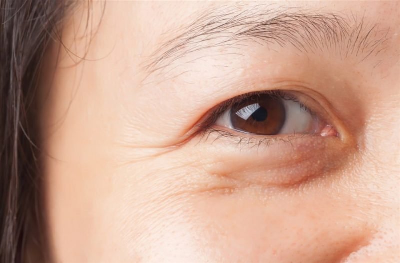 Nguyên nhân hình thành nếp nhăn vùng mắt
