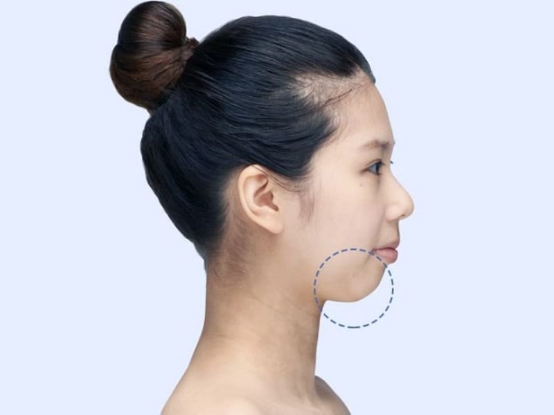 Rủi ro và cách giảm thiểu khi độn sụn cằm