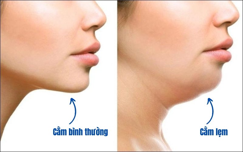 Nguyên nhân gây cằm lẹm và ảnh hưởng đến thẩm mỹ