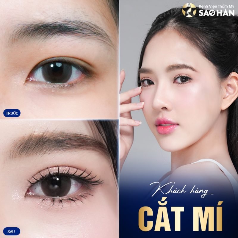 Tại Sao Chọn Bệnh viện Sao Hàn Cho Tạo Mí Đôi Tự Nhiên?