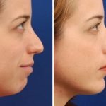 Chỉnh cằm lẹm bằng độn sụn