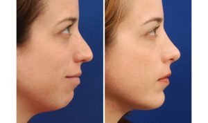 Chỉnh cằm lẹm bằng độn sụn