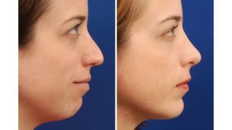 Chỉnh cằm lẹm bằng độn sụn