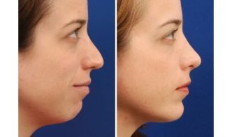 Chỉnh cằm lẹm bằng độn sụn