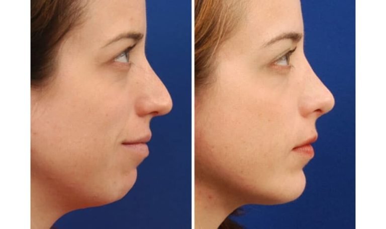 Chỉnh cằm lẹm bằng độn sụn