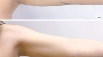 Dịch Vụ Hút Mỡ Tay Giúp Vóc Dáng Thon Gọn