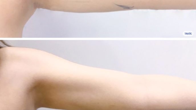 Dịch Vụ Hút Mỡ Tay Giúp Vóc Dáng Thon Gọn