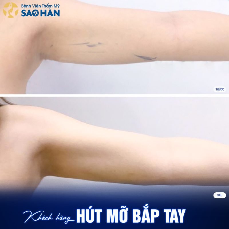 Dịch Vụ Hút Mỡ Tay Giúp Vóc Dáng Thon Gọn