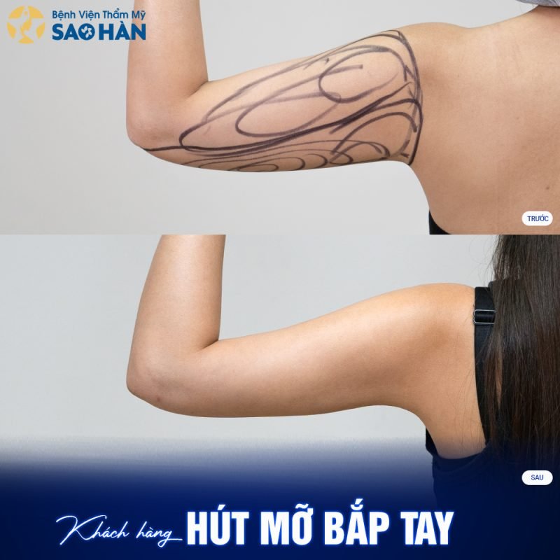 Quy Trình Thực Hiện Dịch Vụ Hút Mỡ Tay Tại Bệnh Viện Thẩm Mỹ Sao Hàn