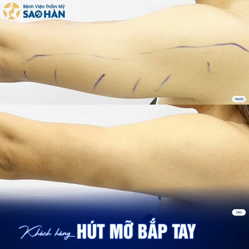 Lý Do Chọn Dịch Vụ Hút Mỡ Tay Tại Bệnh Viện Thẩm Mỹ Sao Hàn
