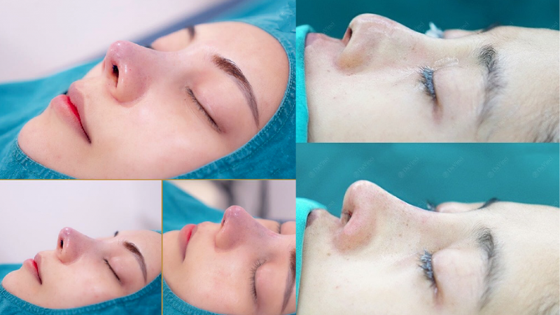lợi ích của việc nâng mũi cấu trúc