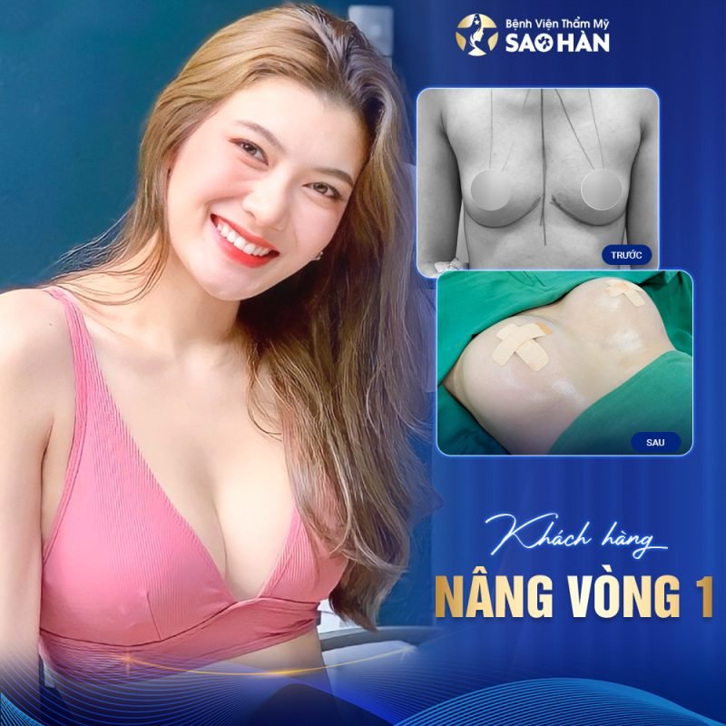 Chăm Sóc Và Phục Hồi Sau Nâng Ngực