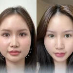 tác hại tiêm botox thon gọn mặt