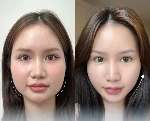 tác hại tiêm botox thon gọn mặt