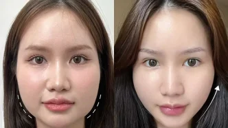 tác hại tiêm botox thon gọn mặt