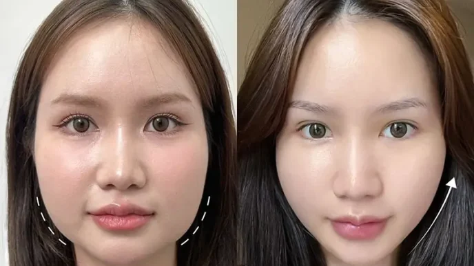 tác hại tiêm botox thon gọn mặt