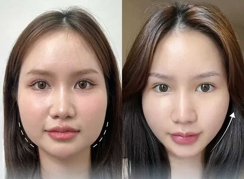 tác hại tiêm botox thon gọn mặt