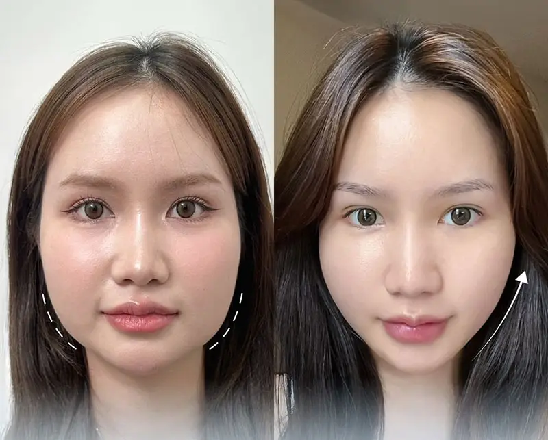 tác hại tiêm botox thon gọn mặt