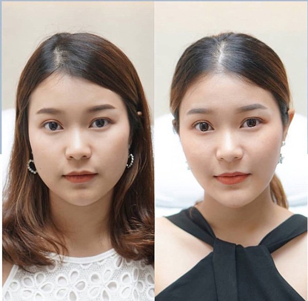 tác hại tiêm botox thon gọn mặt
