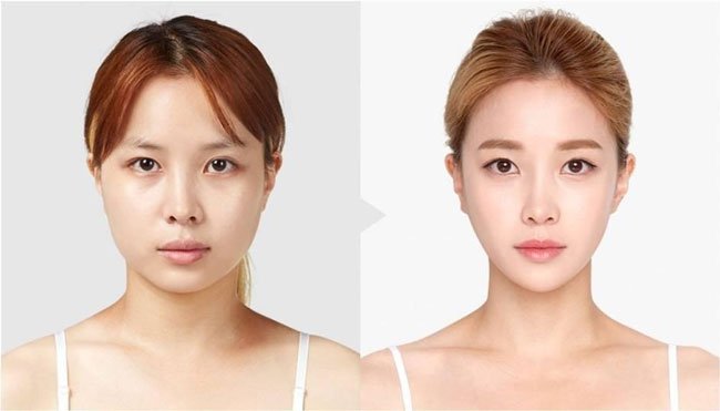 tác hại tiêm botox thon gọn mặt