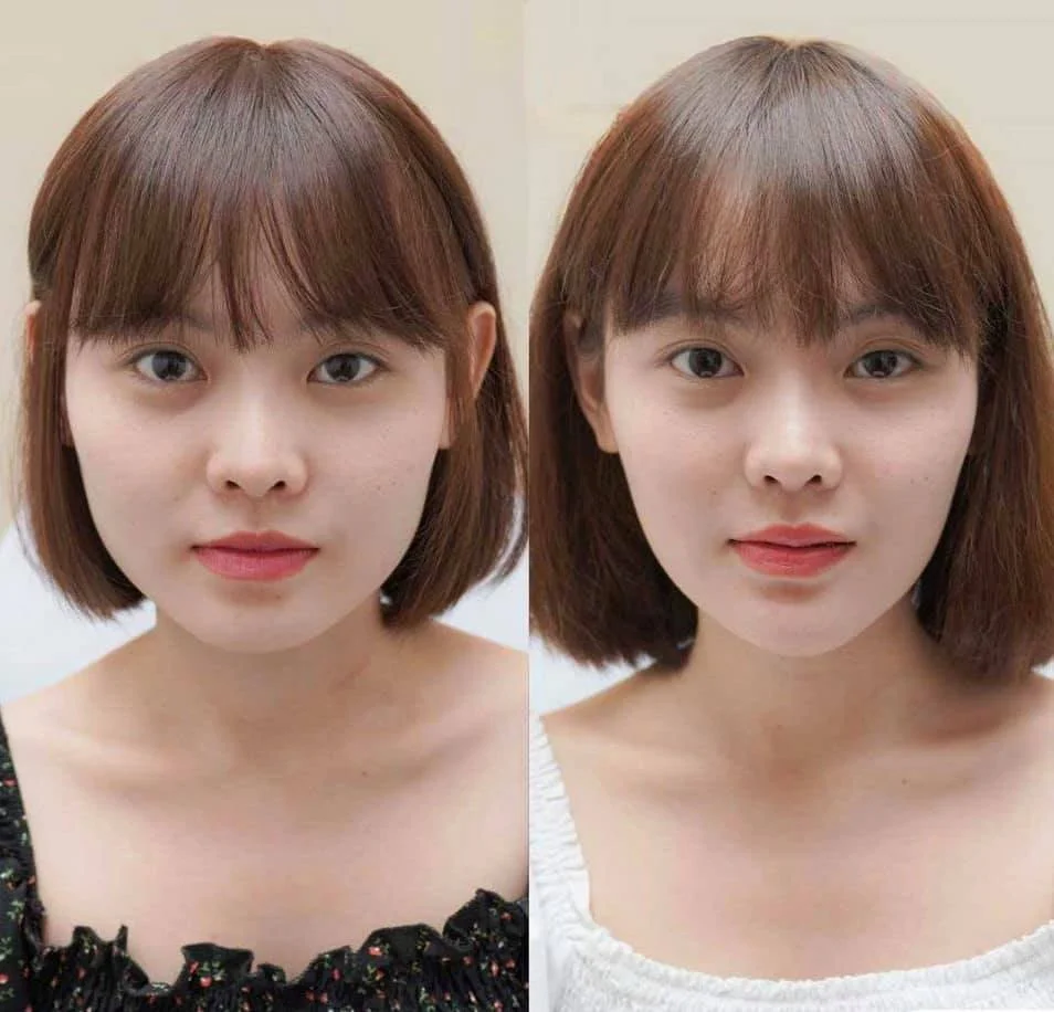 tác hại tiêm botox thon gọn mặt